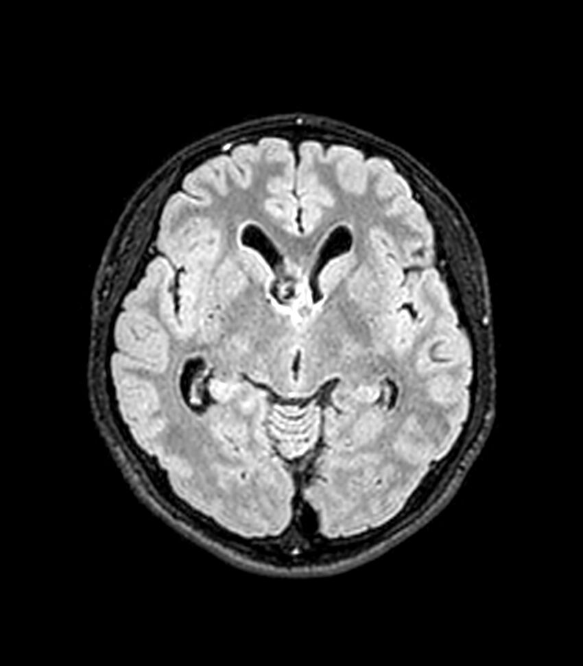 Central neurocytoma (Radiopaedia 79320-92380 Axial FLAIR 175).jpg