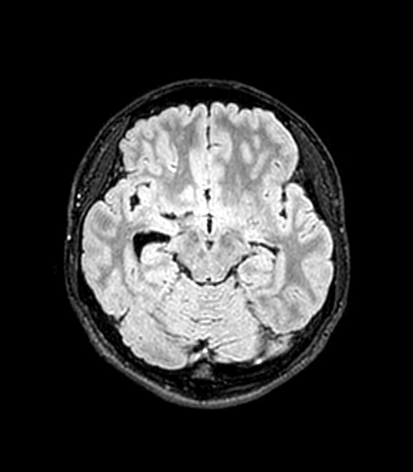 Central neurocytoma (Radiopaedia 79320-92380 Axial FLAIR 190).jpg