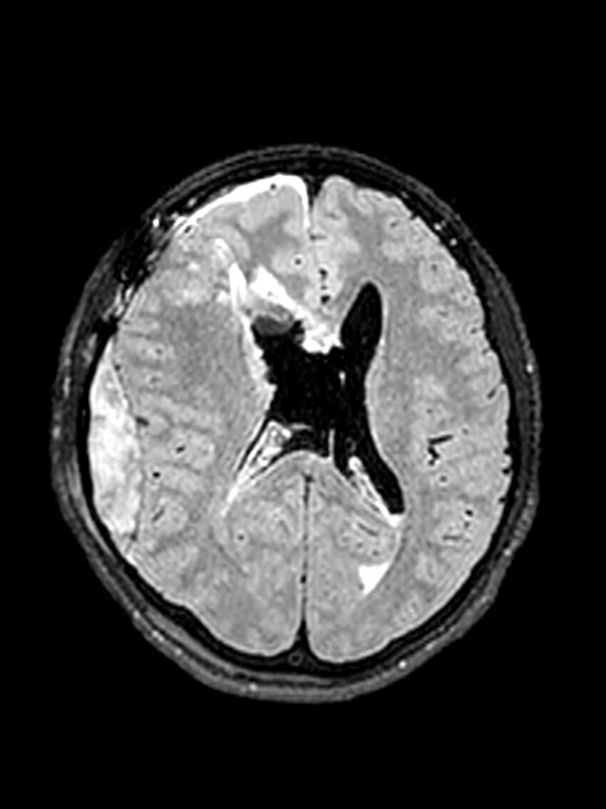 Central neurocytoma (Radiopaedia 79320-92381 Axial FLAIR 75).jpg