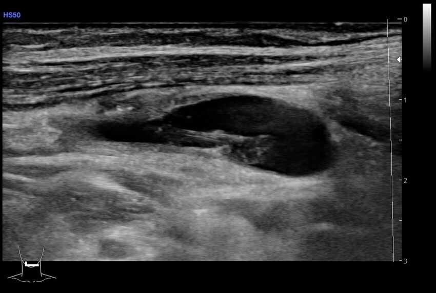 Central venous catheter-related thrombosis (Radiopaedia 61135-69025 Longitudinal 48).jpg