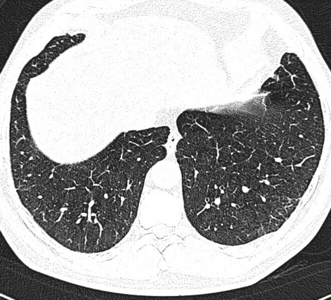 File:Centrilobular pulmonary emphysema (Radiopaedia 26808-26971 Axial lung window 31).jpg