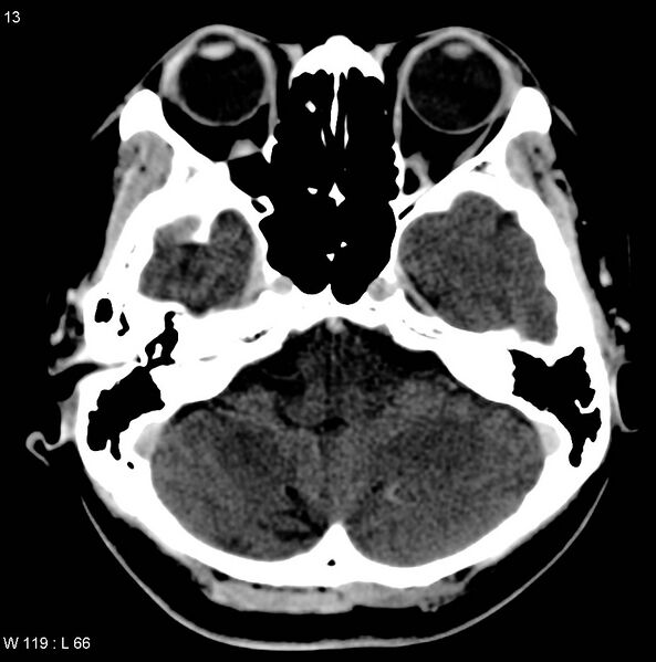 File:Cerebellar arteriovenous malformation (Radiopaedia 5220-36607 A 2).jpg