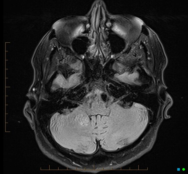 File:Cerebellar gangliocytoma (Radiopaedia 65377-74422 Axial FLAIR 8).jpg