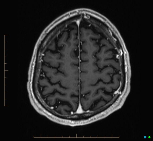 File:Cerebellar gangliocytoma (Radiopaedia 65377-74422 Axial T1 C+ 116).jpg