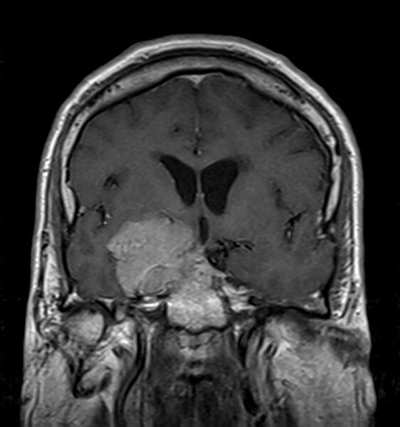 File:Cerebellopontine angle meningioma (Radiopaedia 24459-24764 Coronal T1 C+ 9).jpg