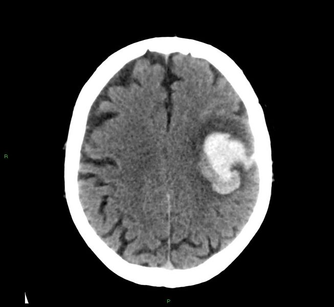 File:Cerebral amyloid angiopathy-associated lobar intracerebral hemorrhage (Radiopaedia 58376-65511 Axial non-contrast 20).jpg