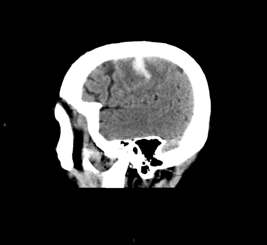 Cerebral amyloid angiopathy-associated lobar intracerebral hemorrhage (Radiopaedia 58376-65511 C 44).jpg