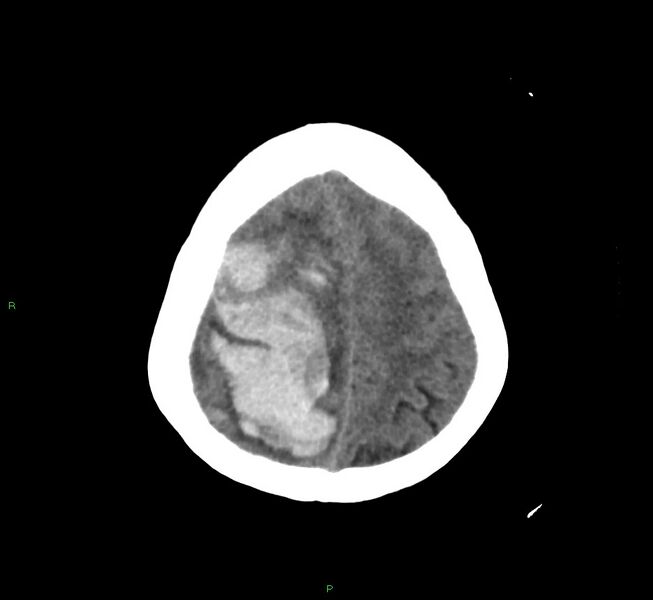 File:Cerebral amyloid angiopathy-associated lobar intracerebral hemorrhage (Radiopaedia 58751-65972 Axial non-contrast 12).jpg