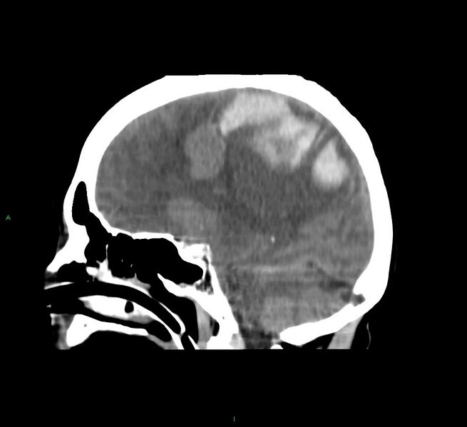 File:Cerebral amyloid angiopathy-associated lobar intracerebral hemorrhage (Radiopaedia 58751-65972 C 26).jpg