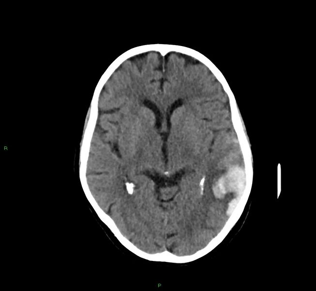 File:Cerebral amyloid angiopathy-associated lobar intracerebral hemorrhage (Radiopaedia 58757-65978 Axial non-contrast 29).jpg