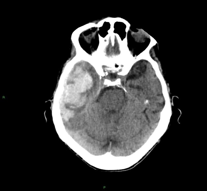 Cerebral amyloid angiopathy-associated lobar intracerebral hemorrhage (Radiopaedia 58758-65980 Axial non-contrast 34).jpg
