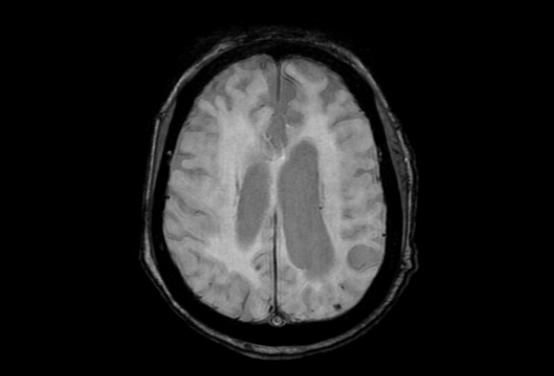 File:Cerebral amyloid angiopathy (Radiopaedia 86671-102792 Axial Gradient Echo 18).jpg