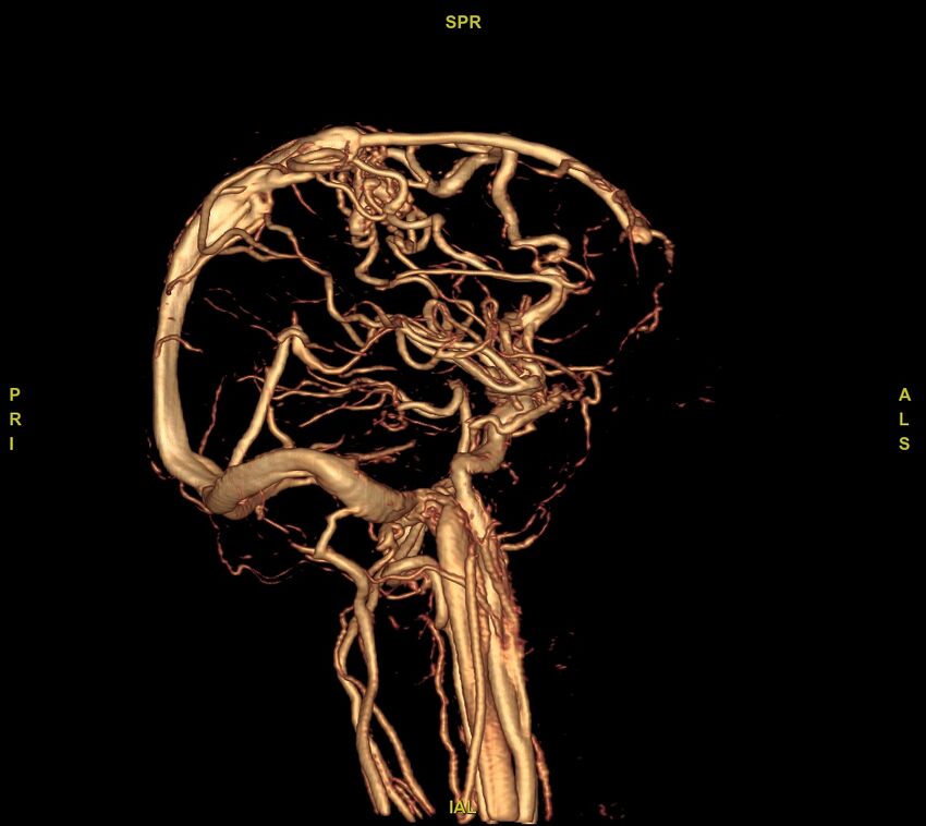 Cerebral arteriovenous malformation (Radiopaedia 61964-70029 VRT 28).jpg