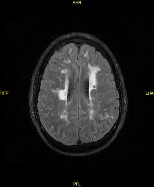 File:Cerebral autosomal dominant arteriopathy with subcortical infarcts and leukoencephalopathy (CADASIL) (Radiopaedia 86108-102054 Axial FLAIR 20).jpg