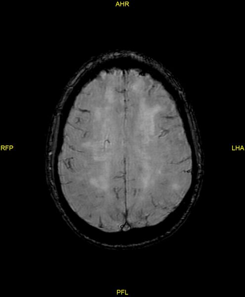 File:Cerebral autosomal dominant arteriopathy with subcortical infarcts and leukoencephalopathy (CADASIL) (Radiopaedia 86108-102054 Axial SWI 75).jpg