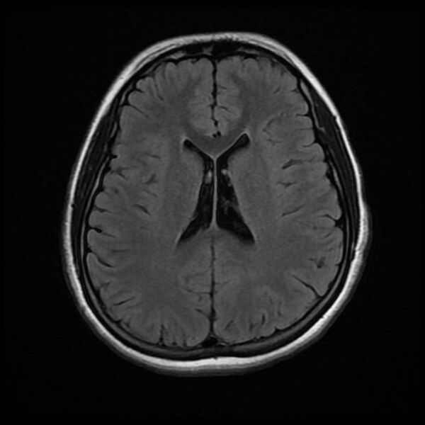 File:Cerebral cavernous malformation (Radiopaedia 44301-47942 Axial FLAIR 13).jpg