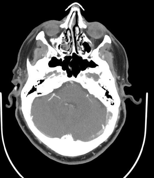File:Cerebral dural venous sinus thrombosis (Radiopaedia 86514-102576 A 37).jpg