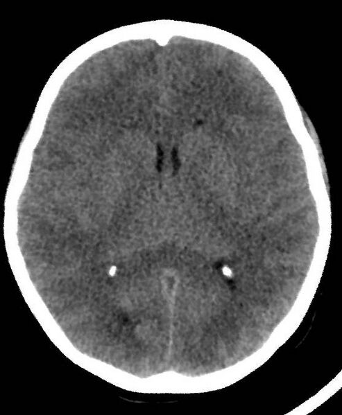 File:Cerebral edema due to severe hyponatremia (Radiopaedia 89826-106937 Axial non-contrast 47).jpg