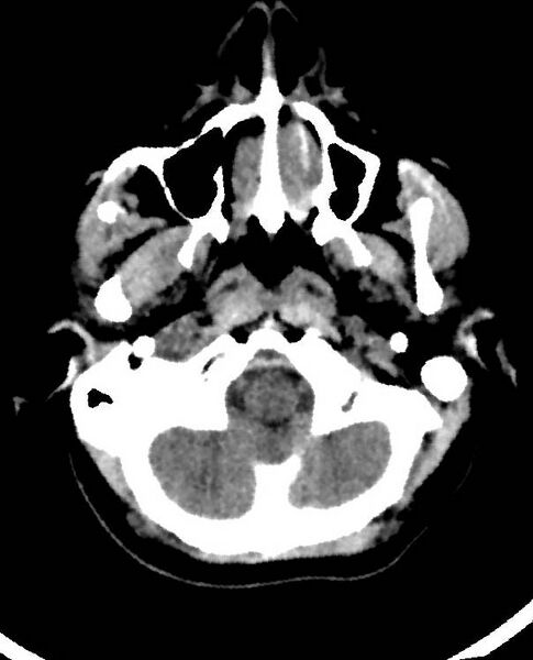 File:Cerebral edema due to severe hyponatremia (Radiopaedia 89826-106938 Axial non-contrast 14).jpg