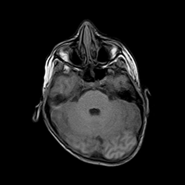 File:Cerebral tuberculoma (Radiopaedia 41152-43932 Axial T1 6).jpg
