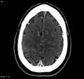 Cerebral vein thrombosis (Radiopaedia 4408-6629 B 1).jpg