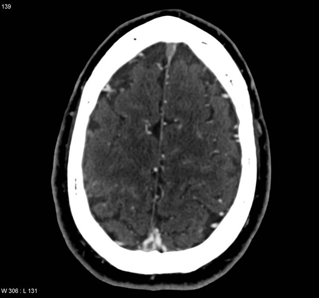 File:Cerebral vein thrombosis (Radiopaedia 4408-6629 B 1).jpg