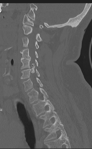 File:Cervical canal stenosis - OPLL and osteophytes (Radiopaedia 47329-51910 Sagittal bone window 46).png