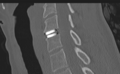 Cervical disc replacement (Radiopaedia 37383-39205 Sagittal bone window 36).png