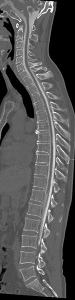 File:Cervical dural CSF leak on MRI and CT treated by blood patch (Radiopaedia 49748-54996 A 9).png