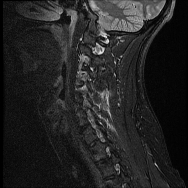 File:Cervical facet fracture and anterior discoligamentous injury (Radiopaedia 32139-33084 Sagittal STIR 4).jpg
