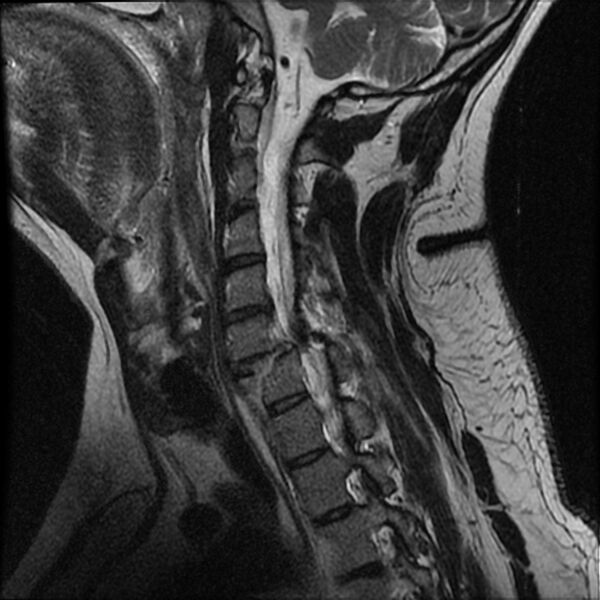 File:Cervical fracture and dislocation with locked facet (Radiopaedia 31837-32781 Sagittal T2 5).jpg