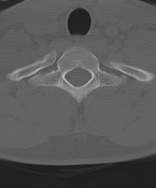 File:Cervical intercalary bone (Radiopaedia 35211-36748 Axial bone window 56).png