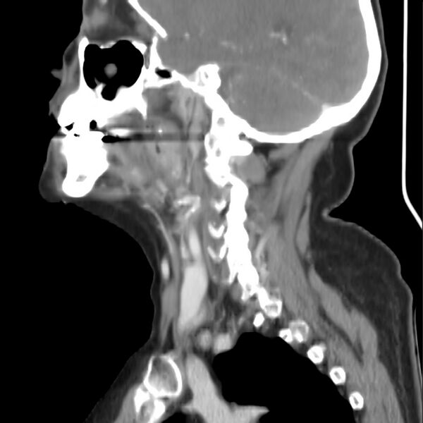 File:Cervical lymphadenopathy- cause unknown (Radiopaedia 22420-22457 D 14).jpg