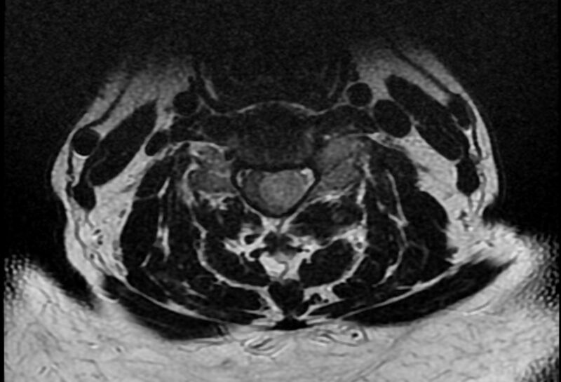 File:Cervical schwannoma (Radiopaedia 72399-82934 Axial T2 11).jpg