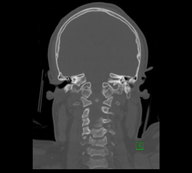File:Cervical spine fracture - hyperflexion injury (Radiopaedia 66184-75364 Coronal bone window 6).jpg