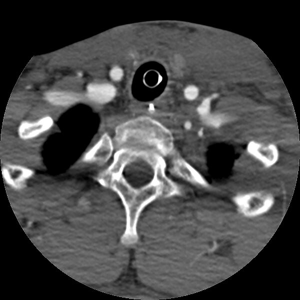 File:Cervical spine fractures with vertebral artery dissection (Radiopaedia 32135-33078 D 19).jpg
