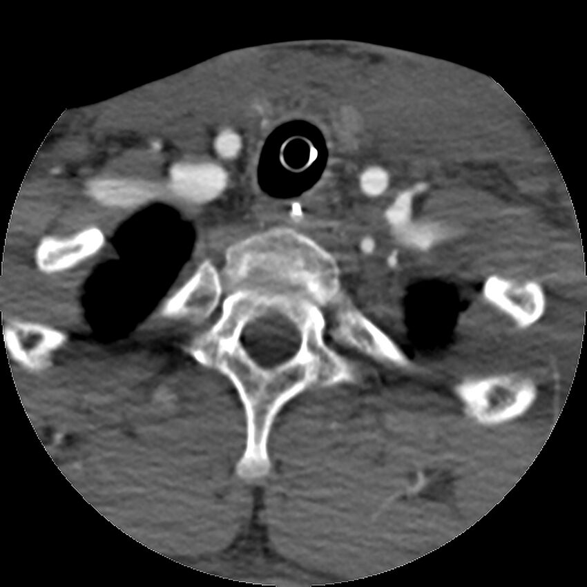 Cervical spine fractures with vertebral artery dissection (Radiopaedia 32135-33078 D 19).jpg
