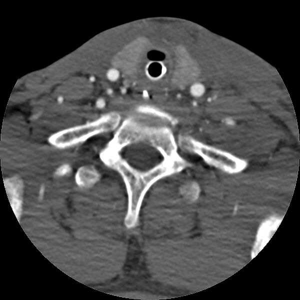 File:Cervical spine fractures with vertebral artery dissection (Radiopaedia 32135-33078 D 24).jpg