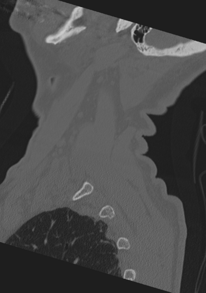 File:Cervical spine fractures with vertebral artery dissection (Radiopaedia 53296-59268 Sagittal bone window 2).png