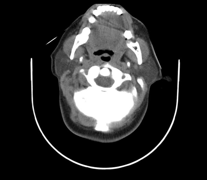 File:Cervical venous malformation (Radiopaedia 22653-22672 Axial non-contrast 21).jpg