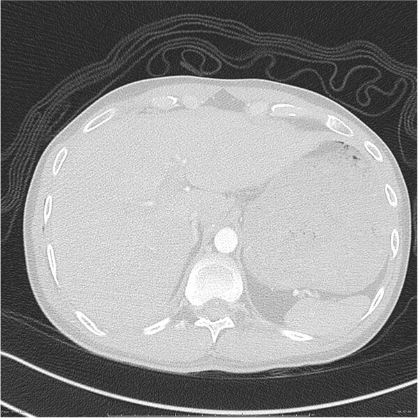 File:Chest and abdomen multi-trauma (Radiopaedia 26294-26425 lung window 97).jpg