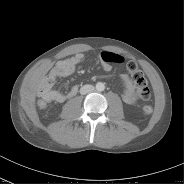 File:Chest and abdomen multi-trauma (Radiopaedia 26294-26426 A 46).jpg