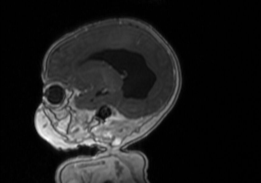 Chiari III malformation with occipital encephalocele (Radiopaedia 79446-92559 Sagittal T1 C+ mpr 46).jpg