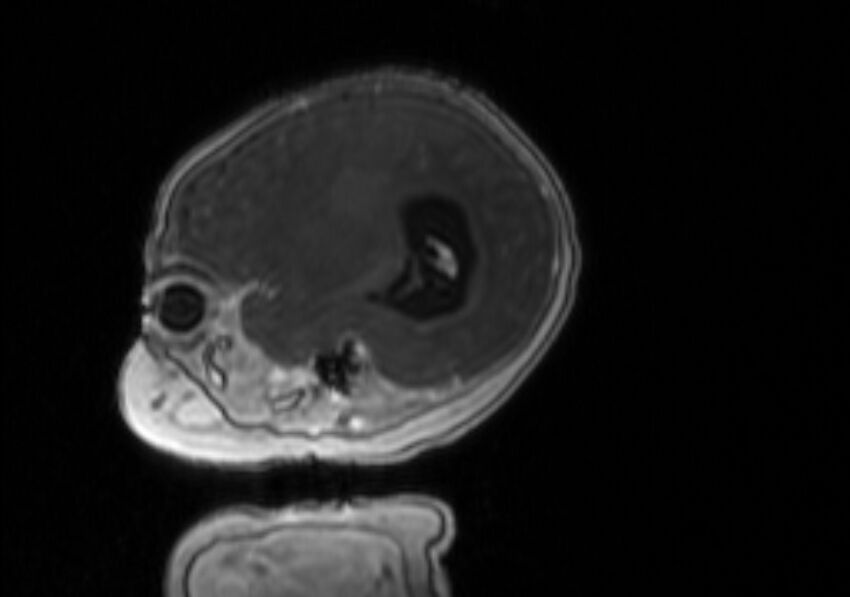 Chiari III malformation with occipital encephalocele (Radiopaedia 79446-92559 Sagittal T1 C+ mpr 50).jpg