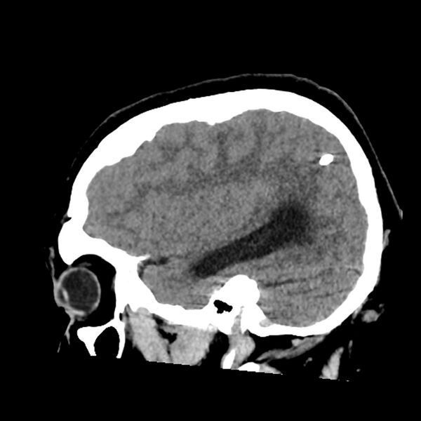 File:Chiasmatic-hypothalamic juvenile pilocytic astrocytoma (Radiopaedia 78533-91237 B 46).jpg