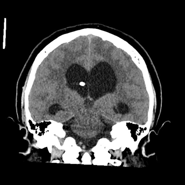 File:Chiasmatic-hypothalamic juvenile pilocytic astrocytoma (Radiopaedia 78533-91237 Coronal non-contrast 41).jpg
