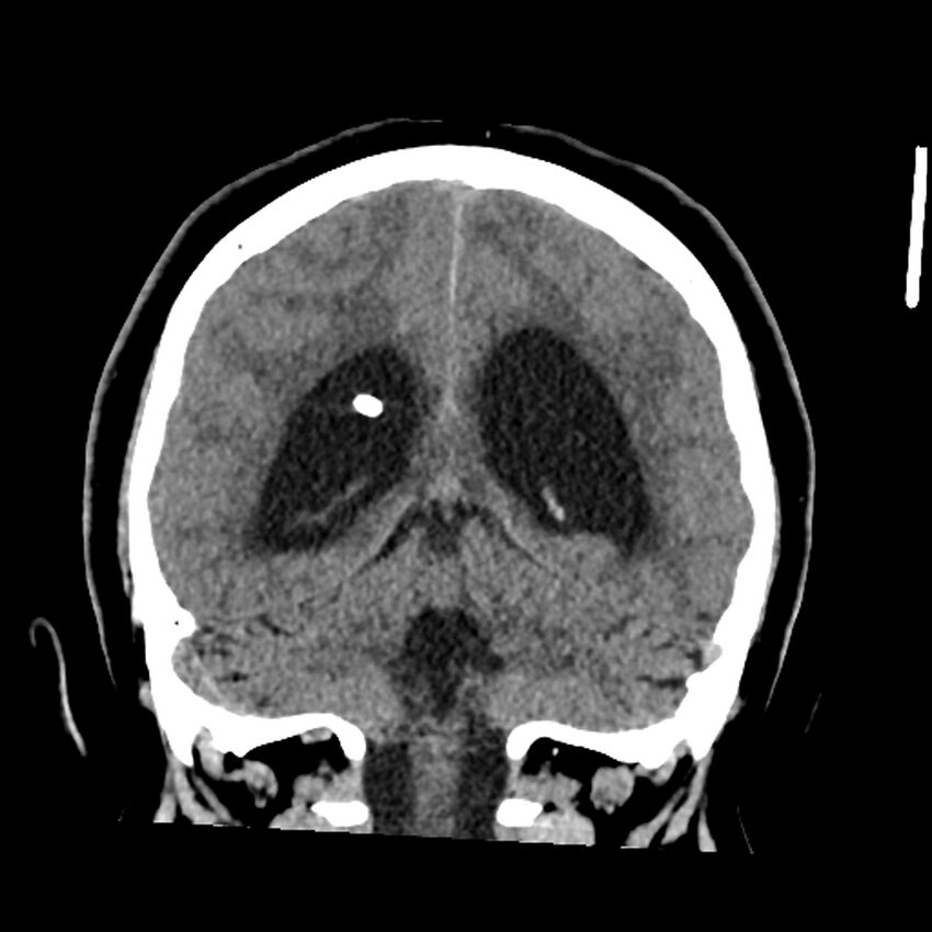 Chiasmatic-hypothalamic juvenile pilocytic astrocytoma (Radiopaedia 78533-91237 Coronal non-contrast 47).jpg