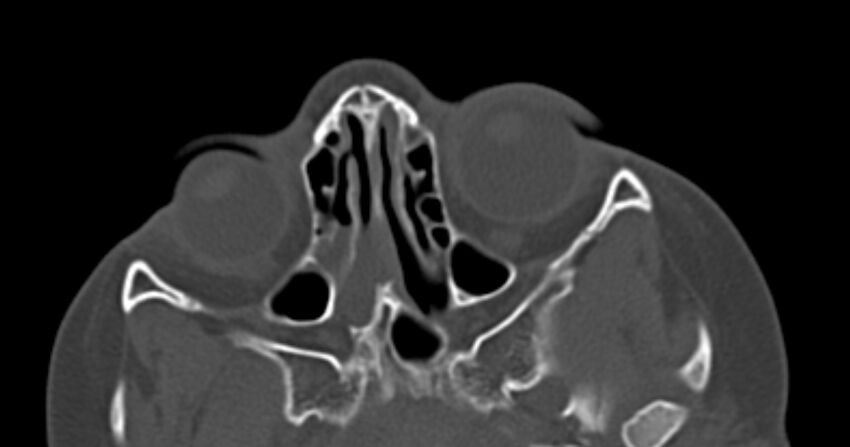 Choanal atresia (Radiopaedia 51295-56972 Axial bone window 35).jpg