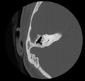Cholesteatoma (Radiopaedia 20296-20217 bone window 33).jpg