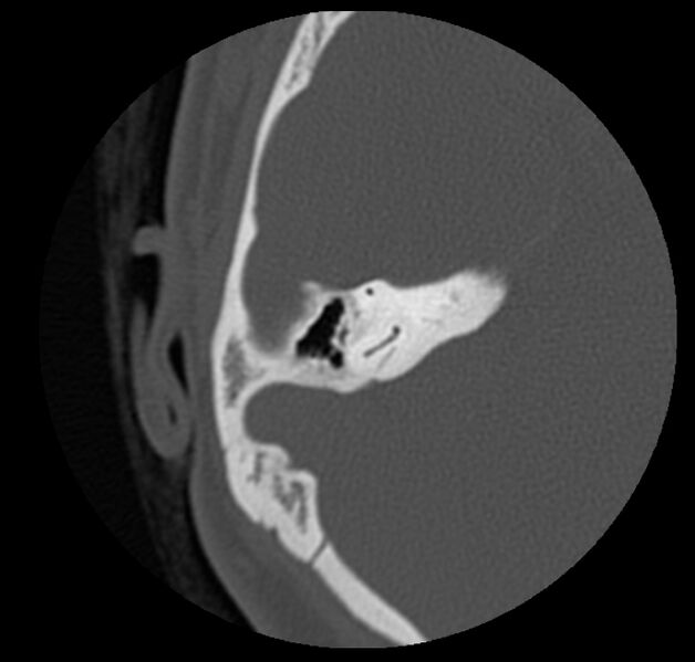 File:Cholesteatoma (Radiopaedia 20296-20217 bone window 33).jpg
